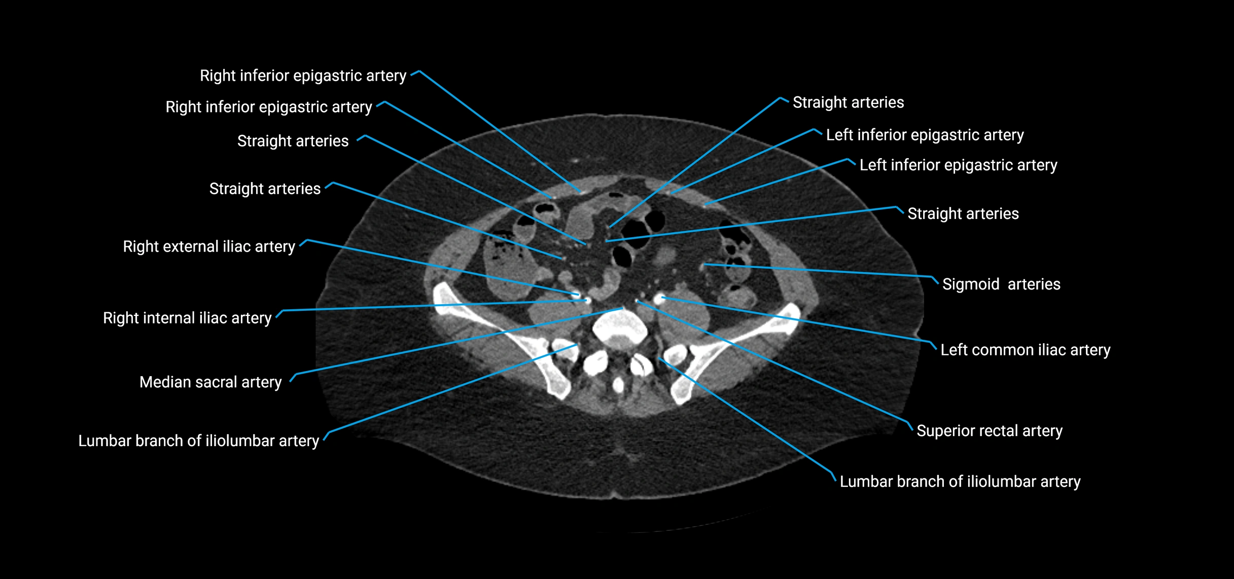 CTA abdomen axial cross sectional anatomy labelled image_172 (2).webp